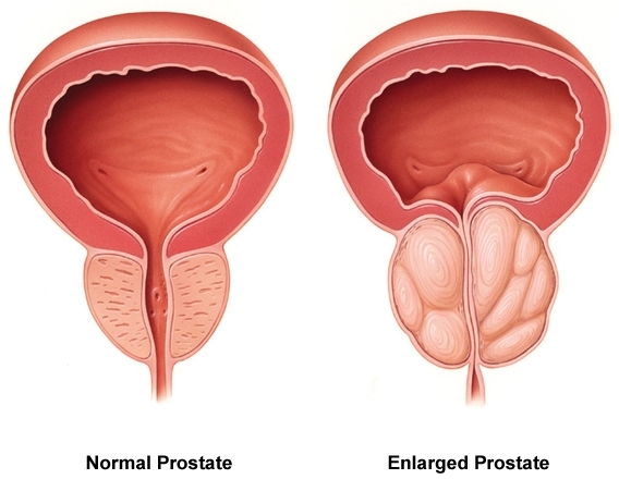 An enlarged prostate can cause a number of problems for men, including sexual dysfunction.